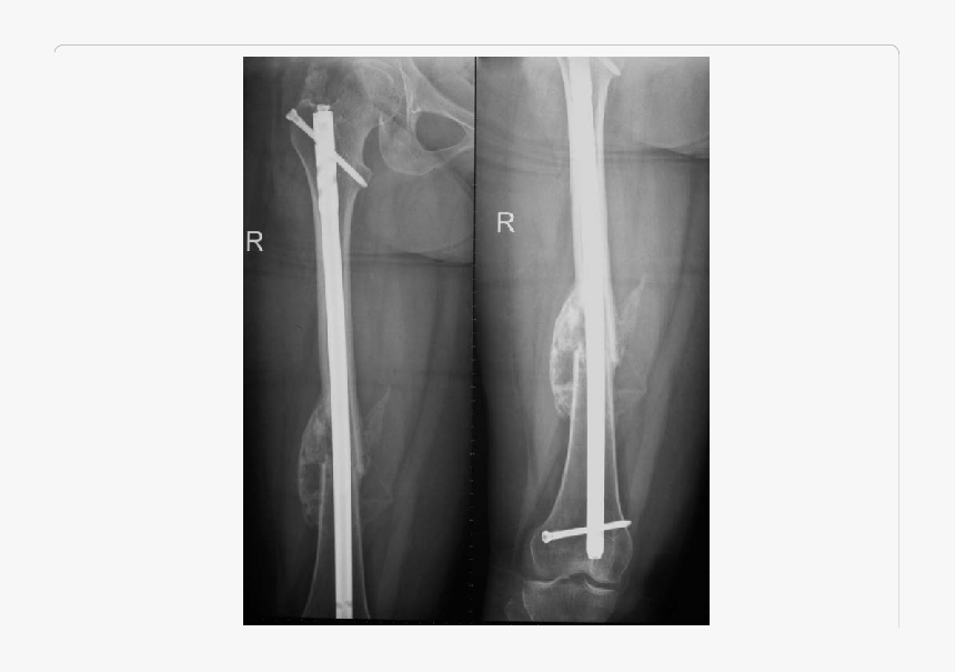 Showing X Ray Of Femur With Accelerated Fracture Healing - Healed Femur X Ray