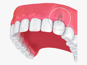 Upper Dental Arch With Zoomed In Internal View Of Dental