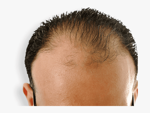 Receding Hairline - Will Castor Oil Regrow Hair