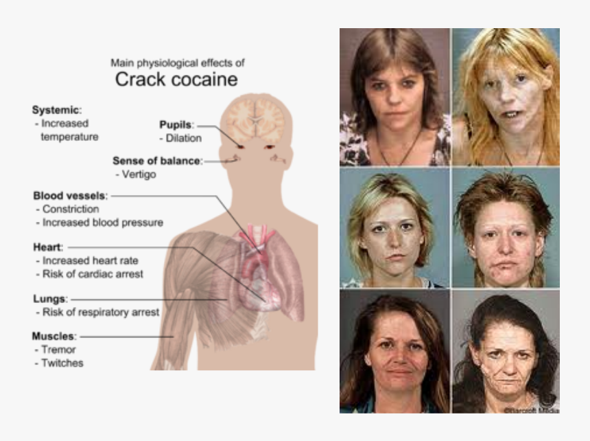 Picture - Effects Of Crack Cocaine