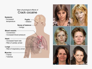 Picture - Effects Of Crack Cocaine