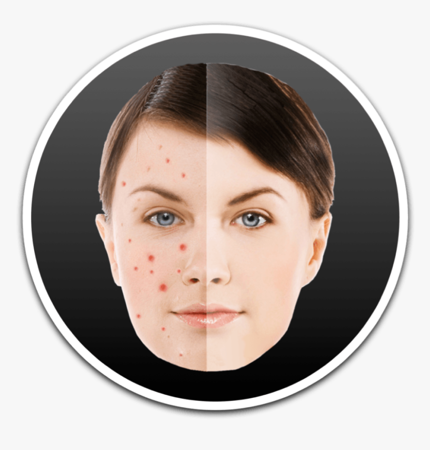 How To Remove Pimples And Blemish From Photos On Mac - Acne