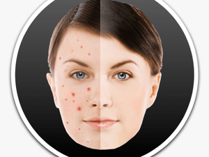 How To Remove Pimples And Blemish From Photos On Mac - Acne