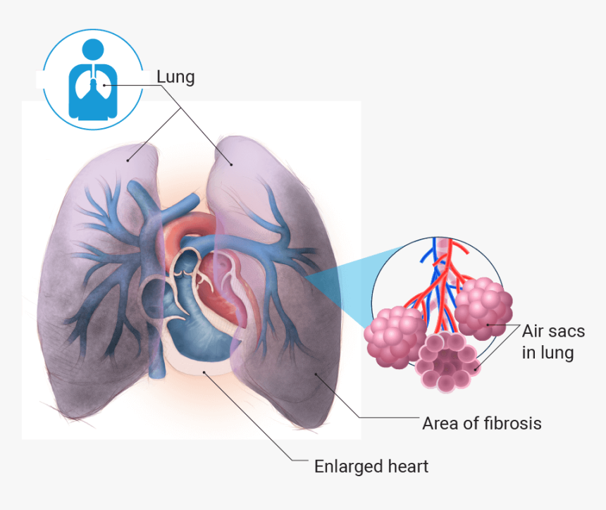 Transparent Lung Png - Pulmonary Hypertension Png Transparent