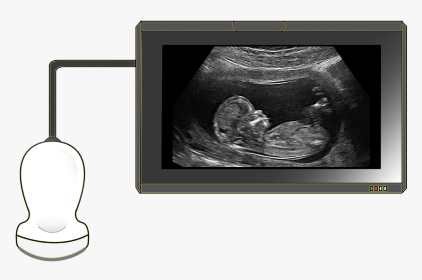 Ultrasound - Polyhydramnios Ultrasound