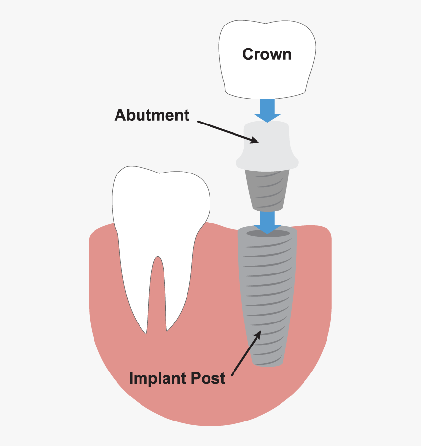 Transparent Tooth Outline Png - Dental Implant Illustration