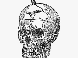 Recovery From The Passage Of An Iron Bar Through The - Phineas Gage Skull